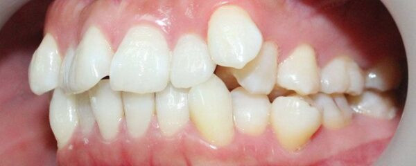 Răng mọc lệch (hô, móm, răng khểnh, chen chúc...) là tình trạng phổ biến, ảnh hưởng đến thẩm mỹ nụ cười và sức khỏe răng miệng, đặc biệt là ở trẻ em. Vậy nguyên nhân nào dẫn đến tình trạng này, nó gây ra những hệ lụy gì và giải pháp nào hiệu quả nhất?